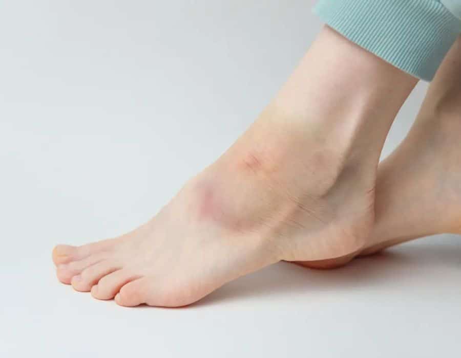 A foot is partially covered by a light blue pant leg, featuring a noticeable bruise on the ankle. It rests against a plain white background.